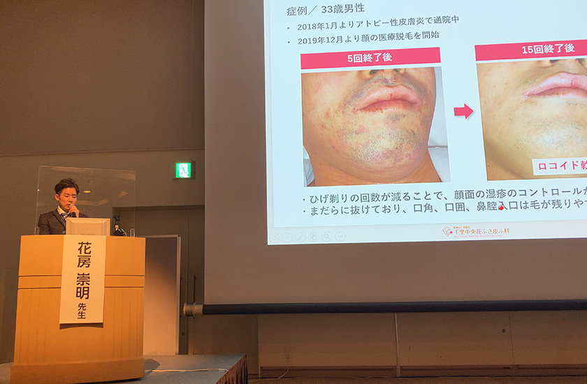 JMEC主催「プロフェッショナルに学ぶ!皮膚科専門医による腋窩多汗症治療」